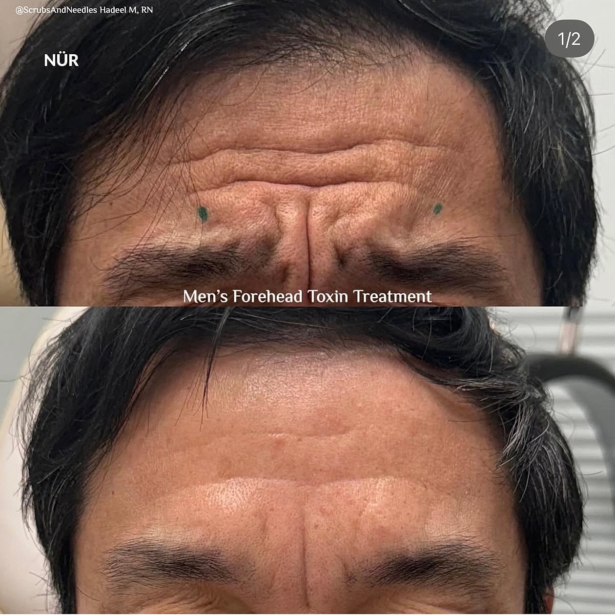 Men's forehead toxin treatment before and after.