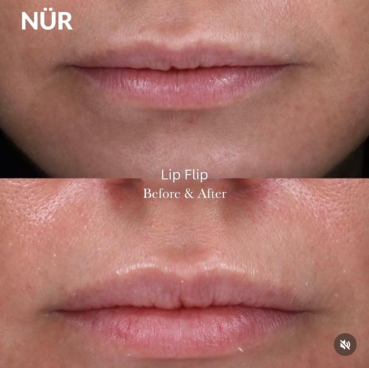 Lip flip treatment before and after comparison.