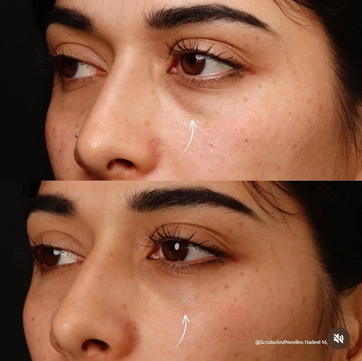 Before and after eye treatment comparison.
