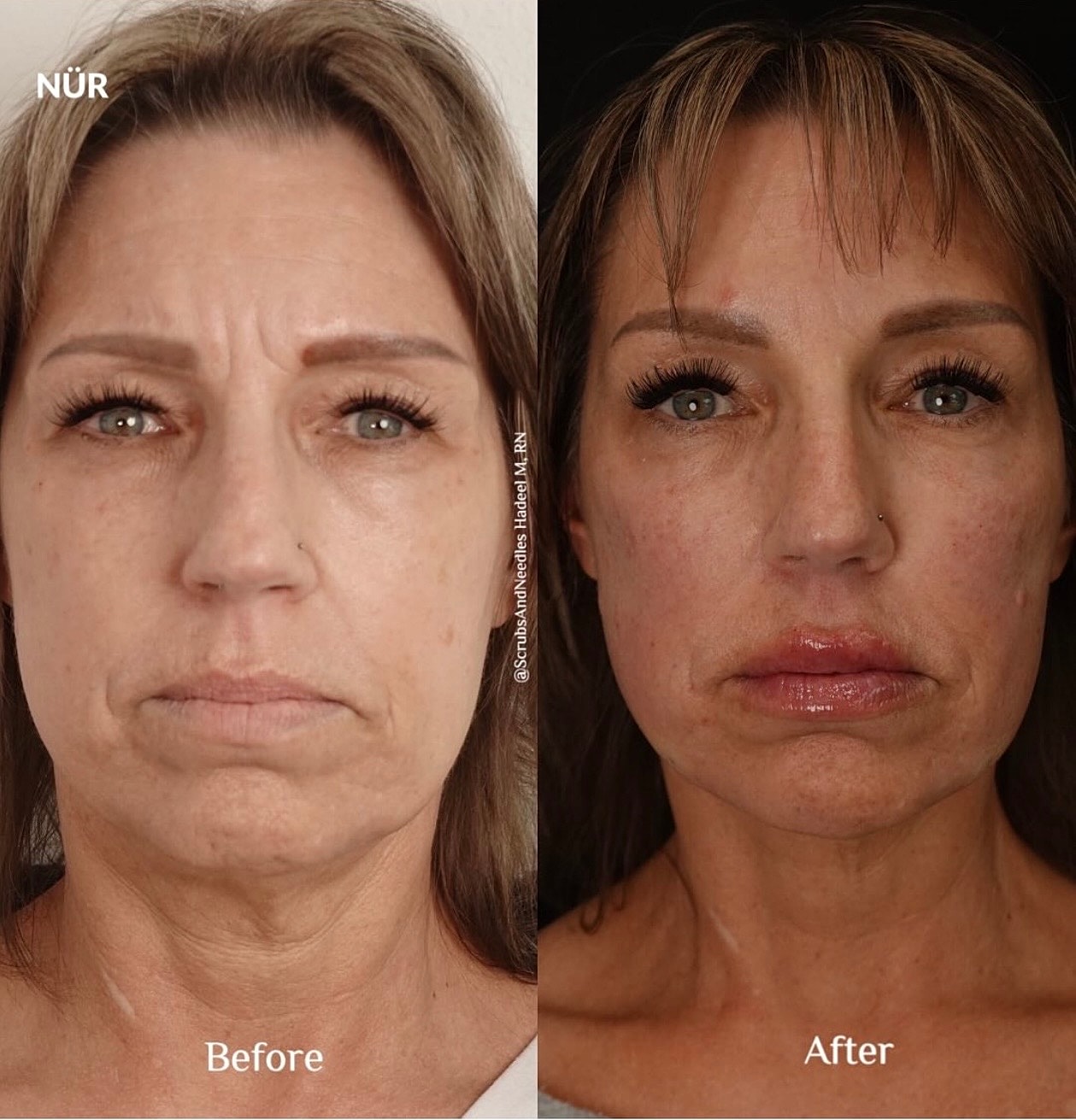 Before and after facial rejuvenation treatment comparison.