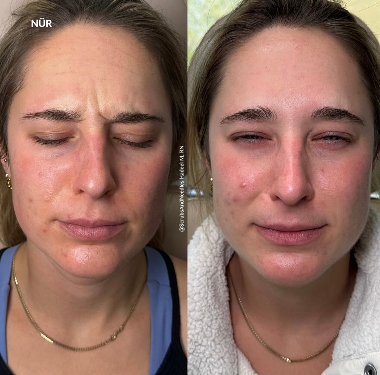 Before and after skincare treatment comparison.