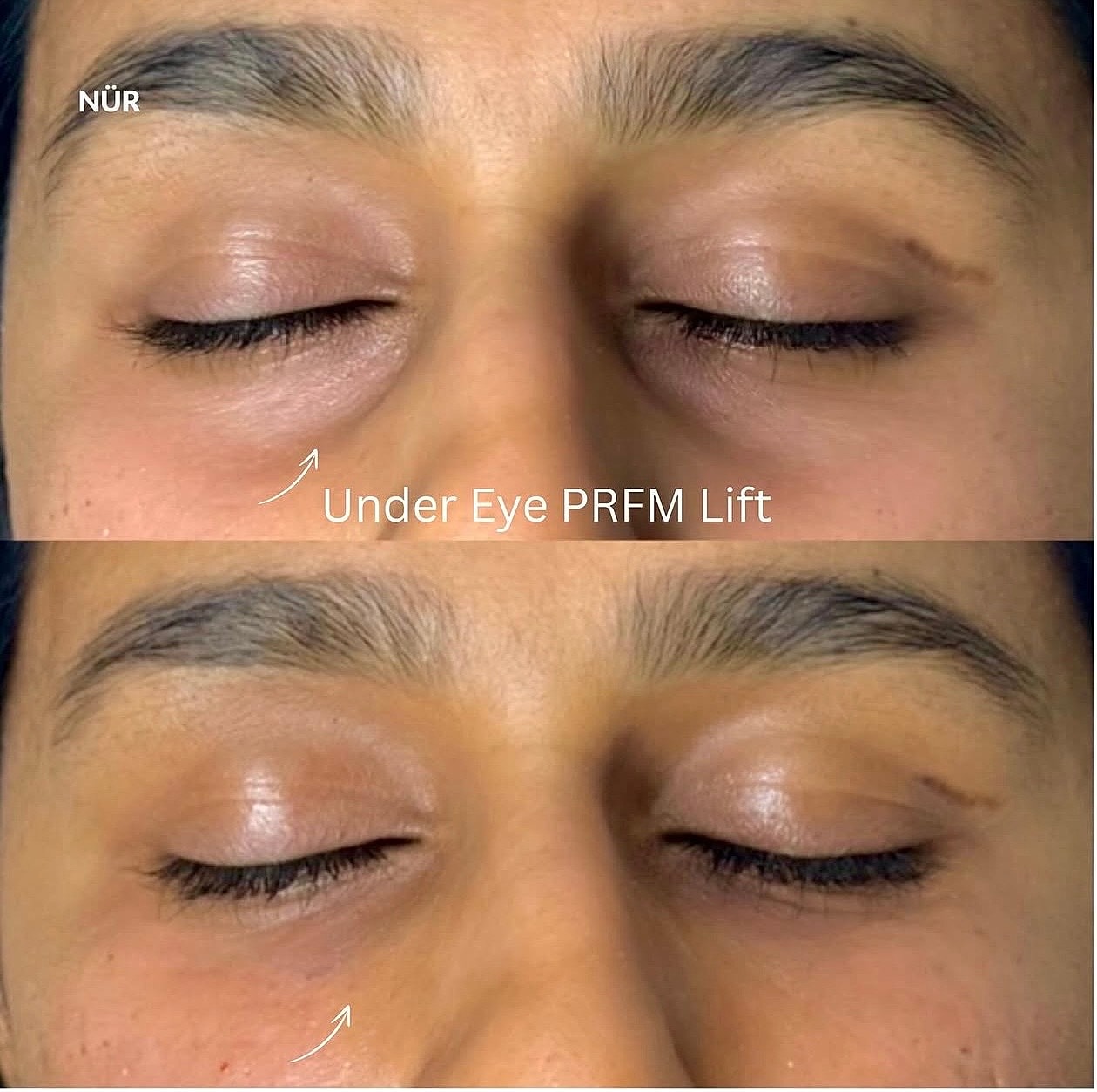 Before and after under eye PRFM lift treatment