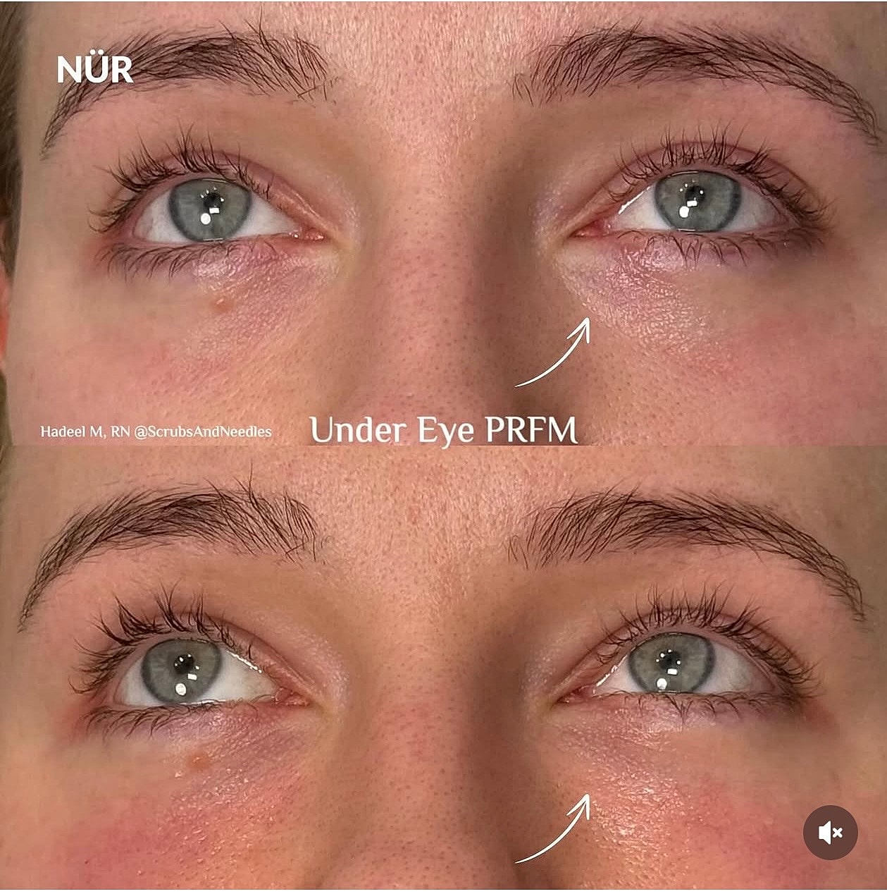 Before and after under eye PRFM treatment.