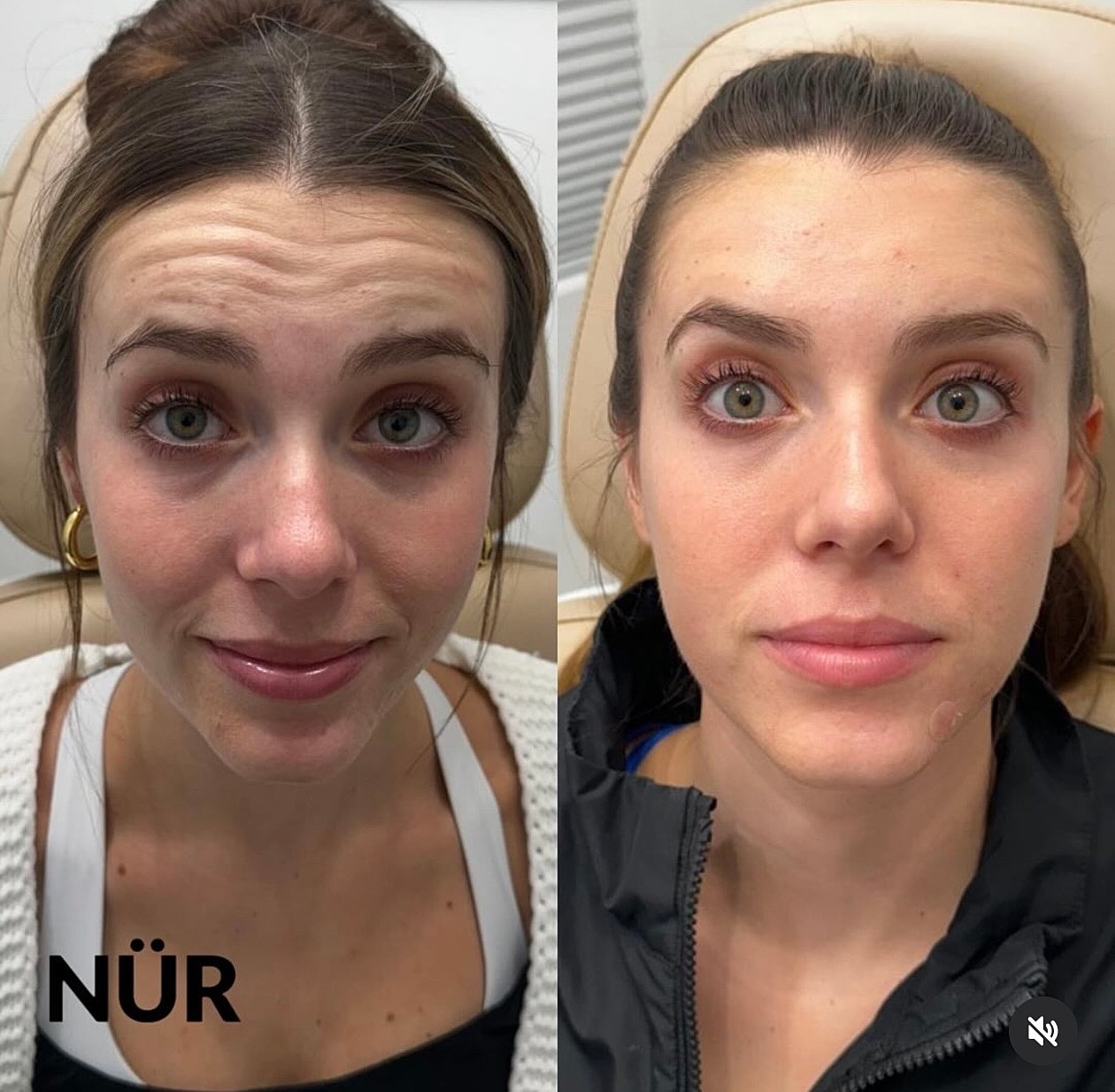 Before and after beauty treatment comparison image.