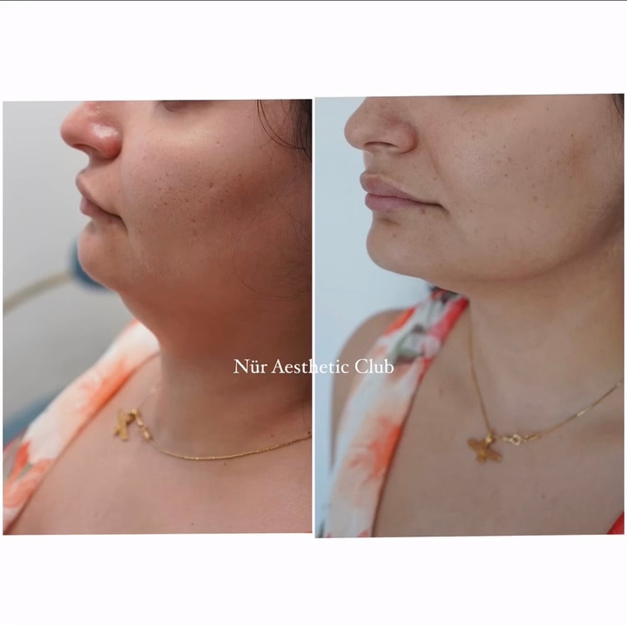 Before and after aesthetic treatment comparison image