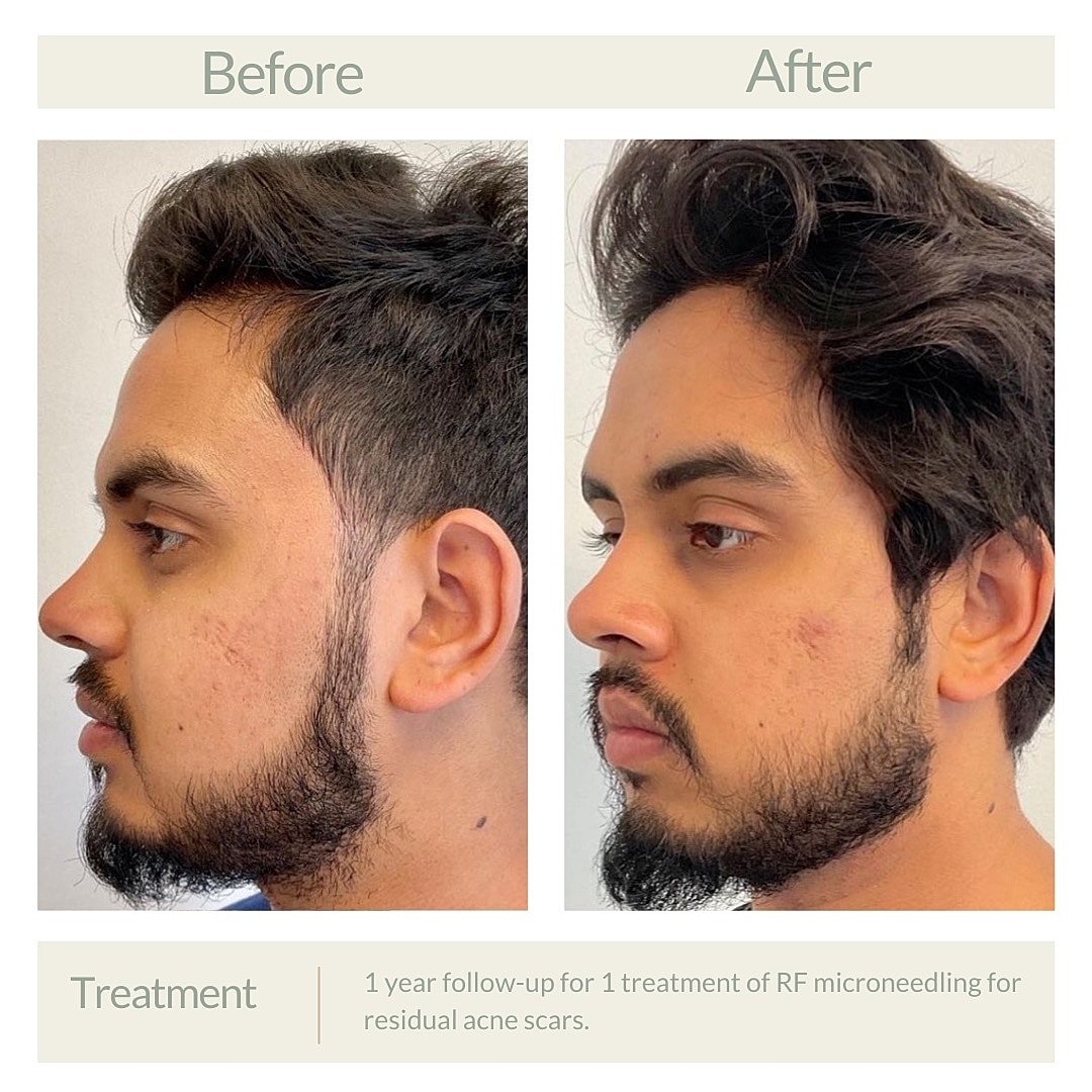 Before and after RF microneedling for acne scars.